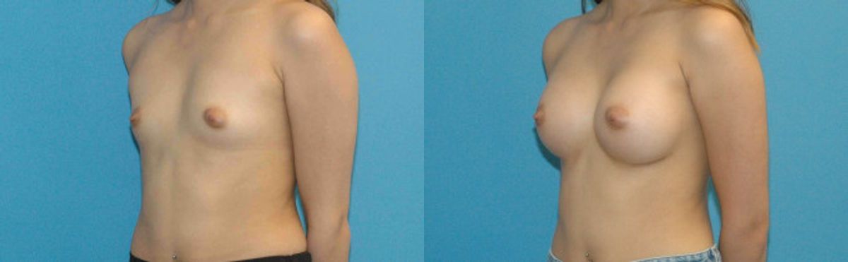 Breast Implant #84 - Before and After