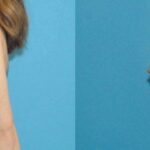 Breast Implant #84 - Before and After