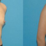 Breast Implant #84 - Before and After
