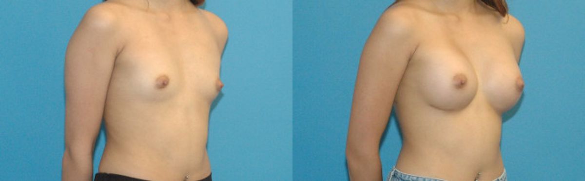 Breast Implant #84 - Before and After