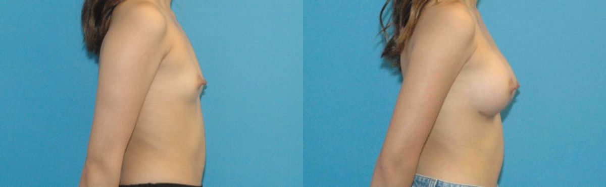 Breast Implant #84 - Before and After