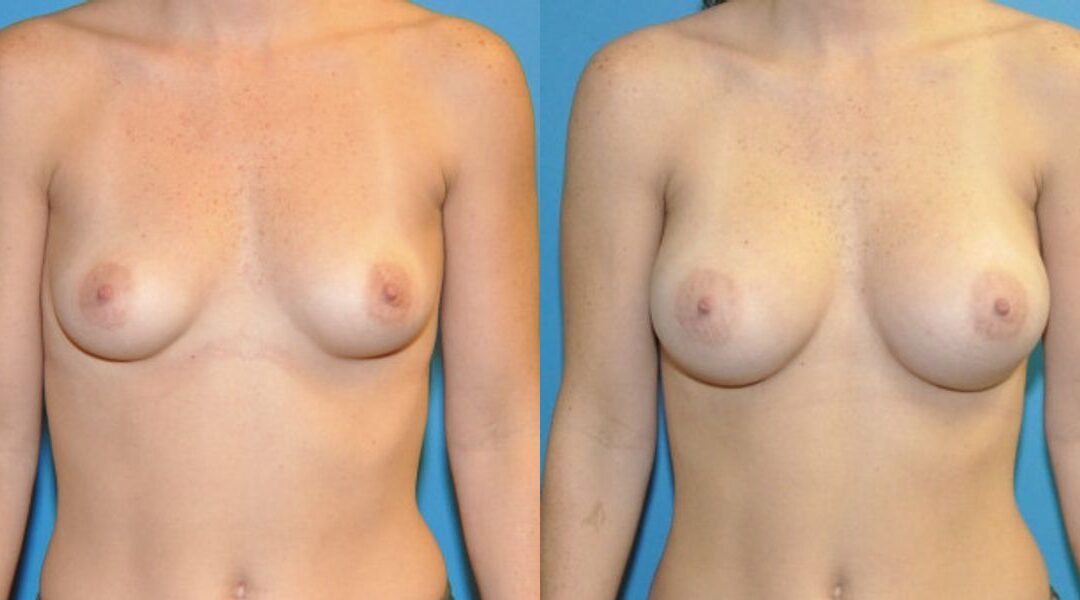 Breast Implant #85