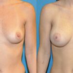 Breast Implant #85 - Before and After