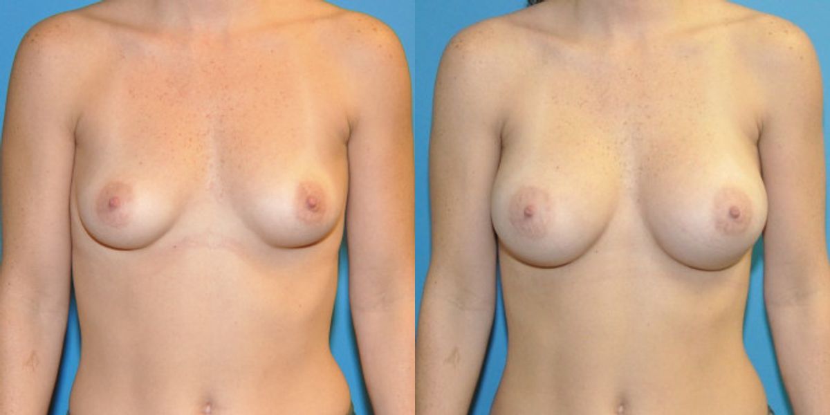 Breast Implant #85 - Before and After