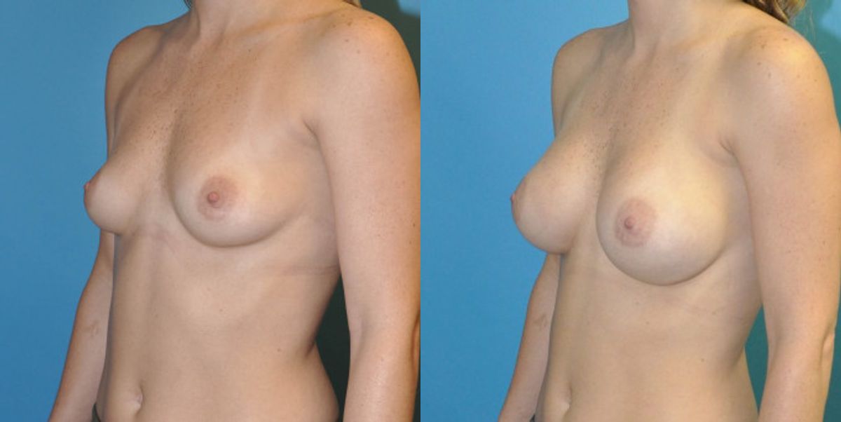 Breast Implant #85 - Before and After