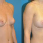 Breast Implant #85 - Before and After