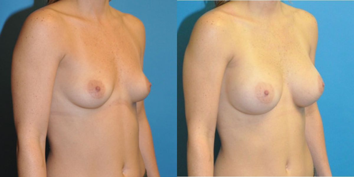 Breast Implant #85 - Before and After