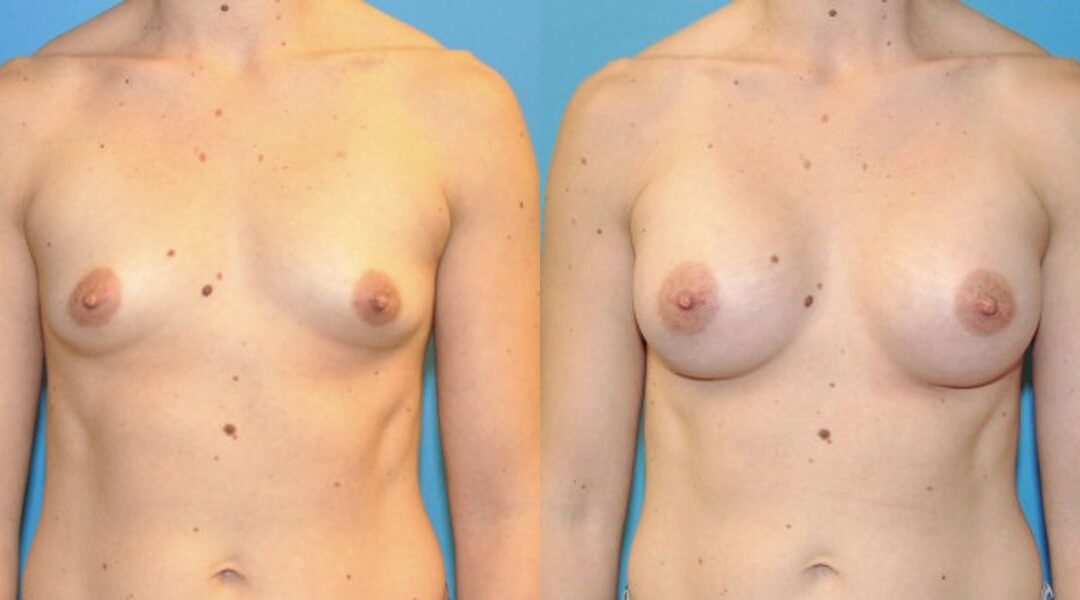 Breast Implant #86