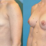 Breast Implant #86 - Before and After