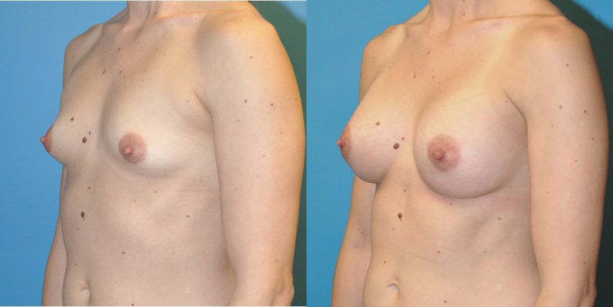 Breast Implant #86 - Before and After