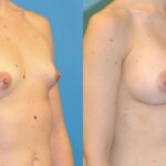 Breast Implant #86 - Before and After