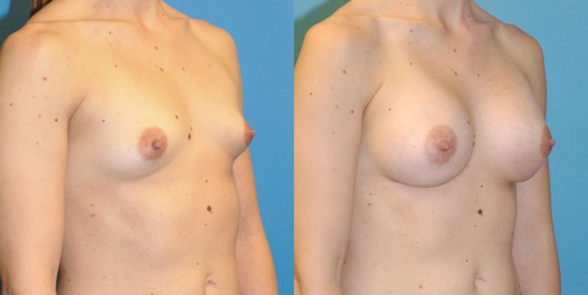 Breast Implant #86 - Before and After