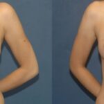 Breast Implant #87 - Before and After