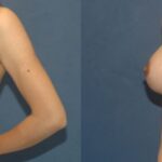 Breast Implant #87 - Before and After