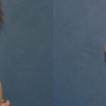 Breast Implant #87 - Before and After