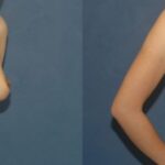 Breast Implant #87 - Before and After