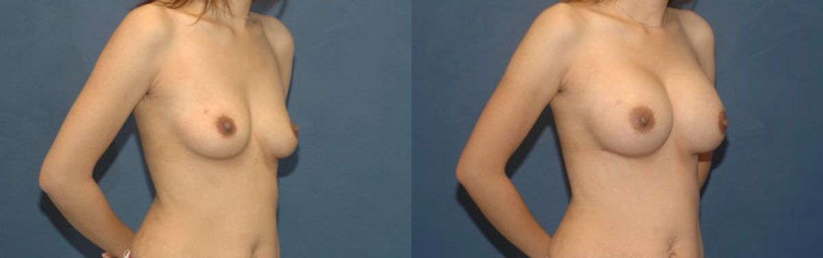 Breast Implant #87 - Before and After