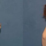 Breast Implant #87 - Before and After