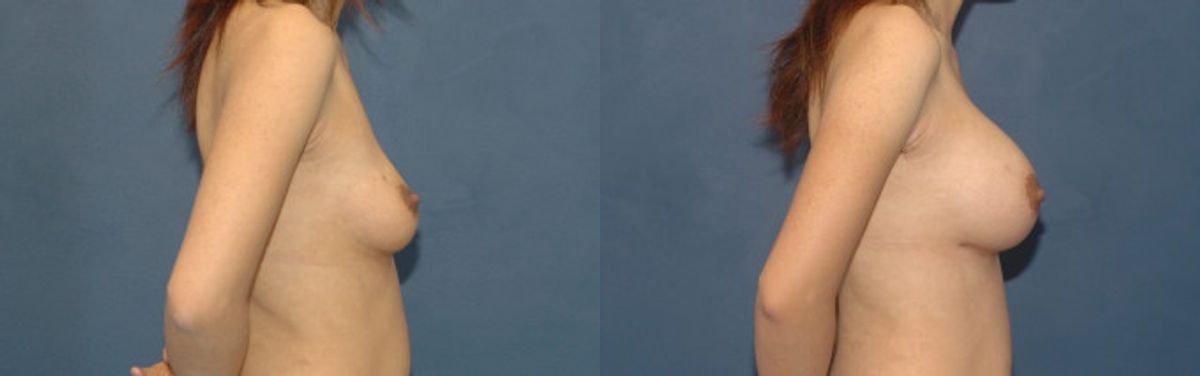 Breast Implant #87 - Before and After