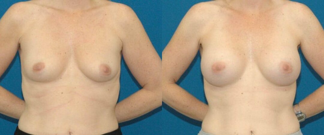 Breast Implant #88