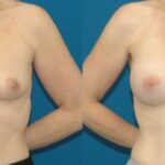 Breast Implant #88 - Before and After