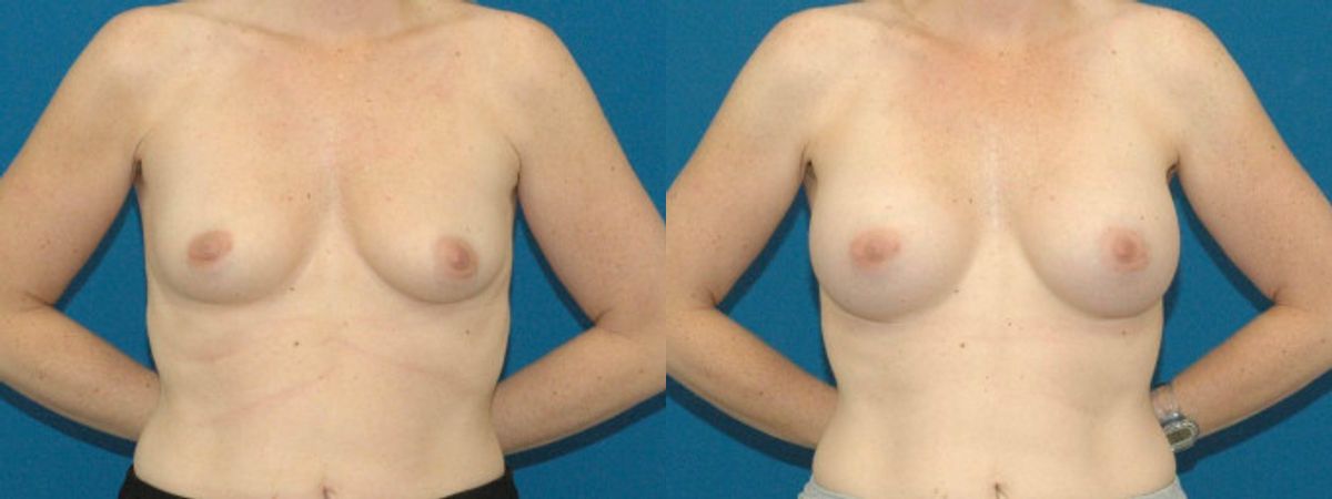Breast Implant #88 - Before and After