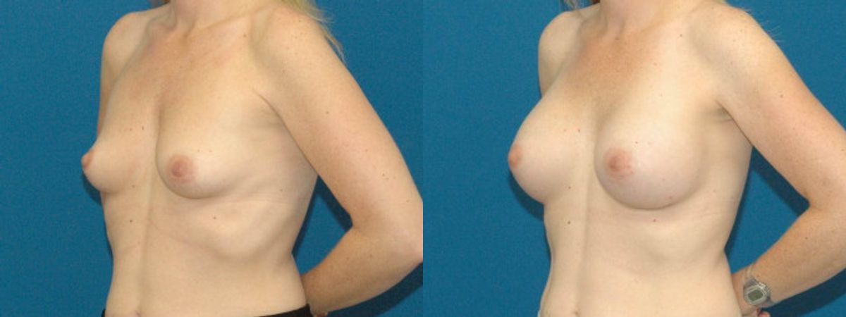 Breast Implant #88 - Before and After