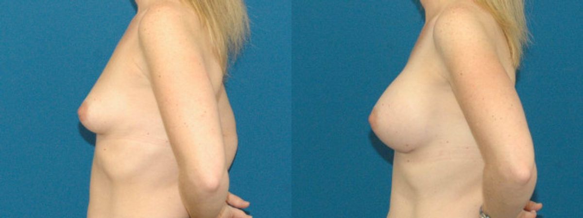 Breast Implant #88 - Before and After