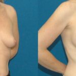 Breast Implant #88 - Before and After