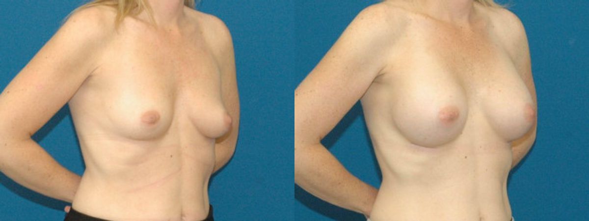 Breast Implant #88 - Before and After