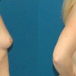 Breast Implant #88 - Before and After