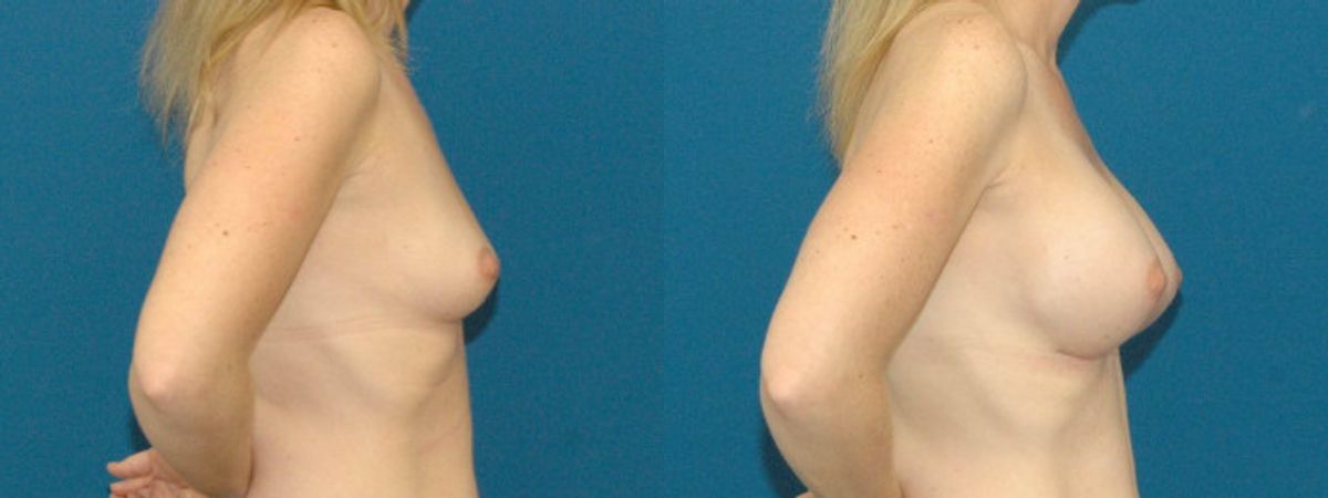 Breast Implant #88 - Before and After