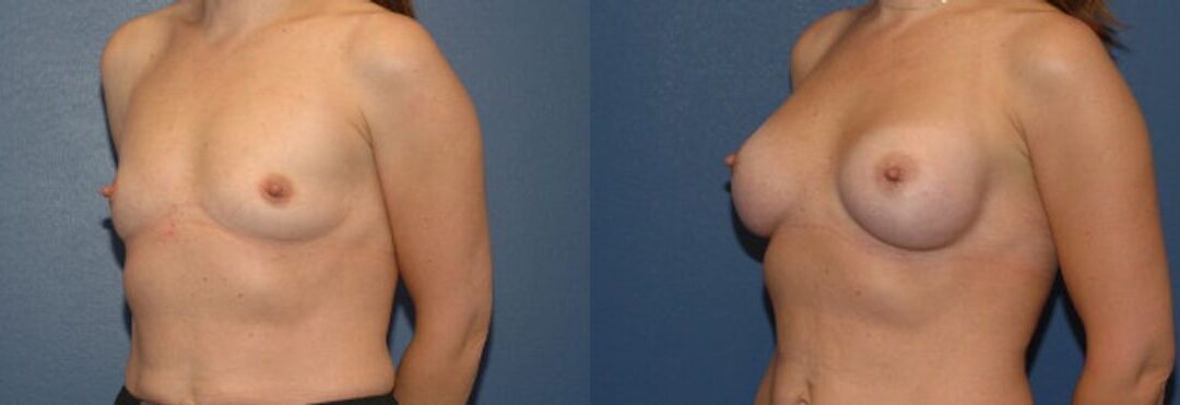 Breast Implant #89