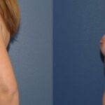 Breast Implant #89 - Before and After