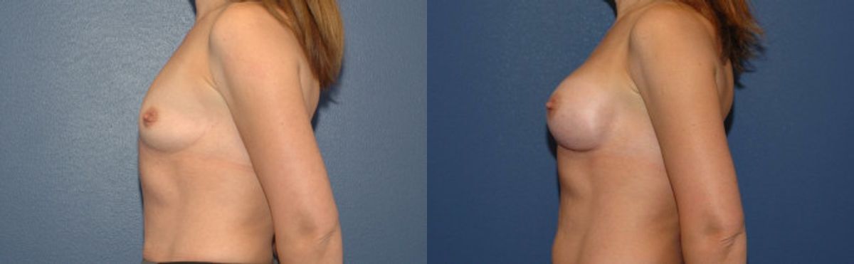 Breast Implant #89 - Before and After