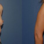 Breast Implant #89 - Before and After