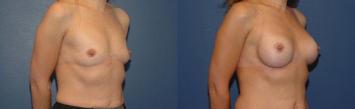 Breast Implant #89 - Before and After