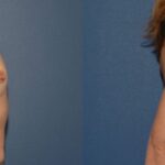 Breast Implant #89 - Before and After