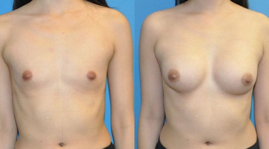 Breast Implant #90