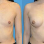 Breast Implant #90 - Before and After