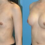 Breast Implant #90 - Before and After