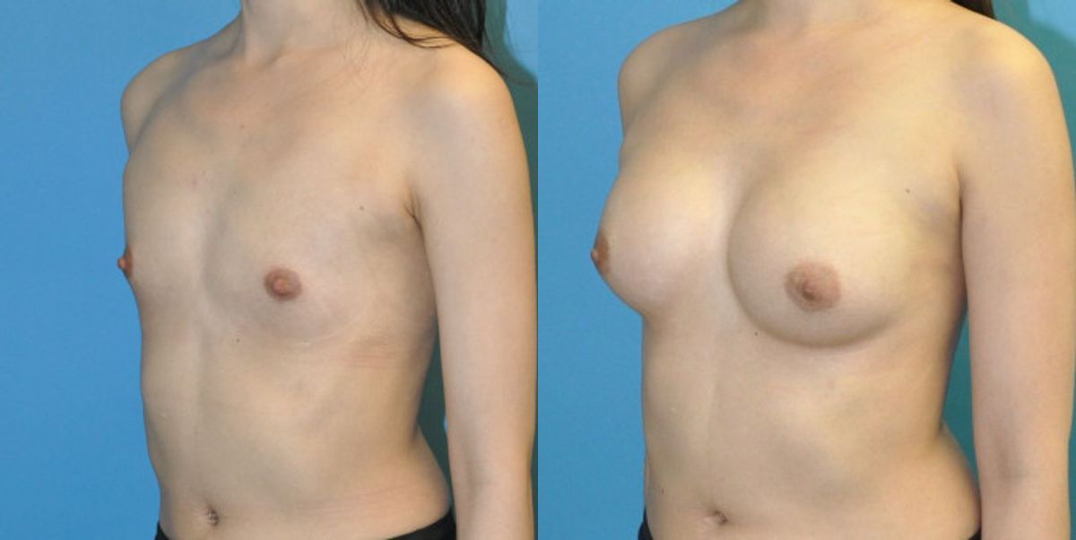 Breast Implant #90 - Before and After