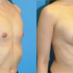 Breast Implant #90 - Before and After