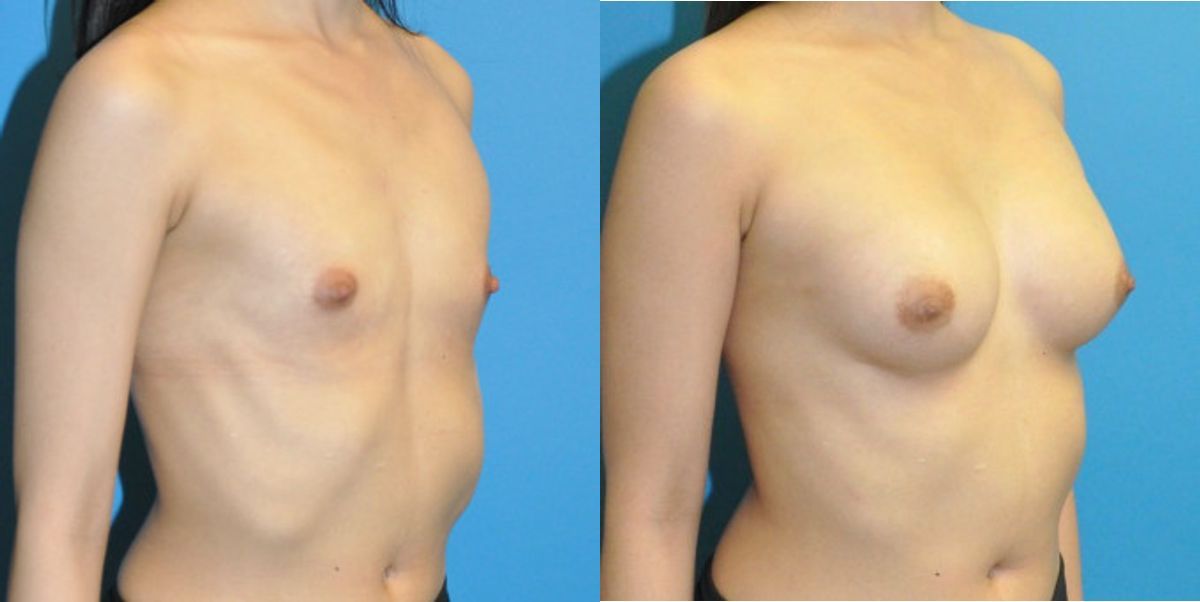 Breast Implant #90 - Before and After