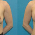 Breast Implant #91 - Before and After