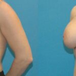 Breast Implant #91 - Before and After