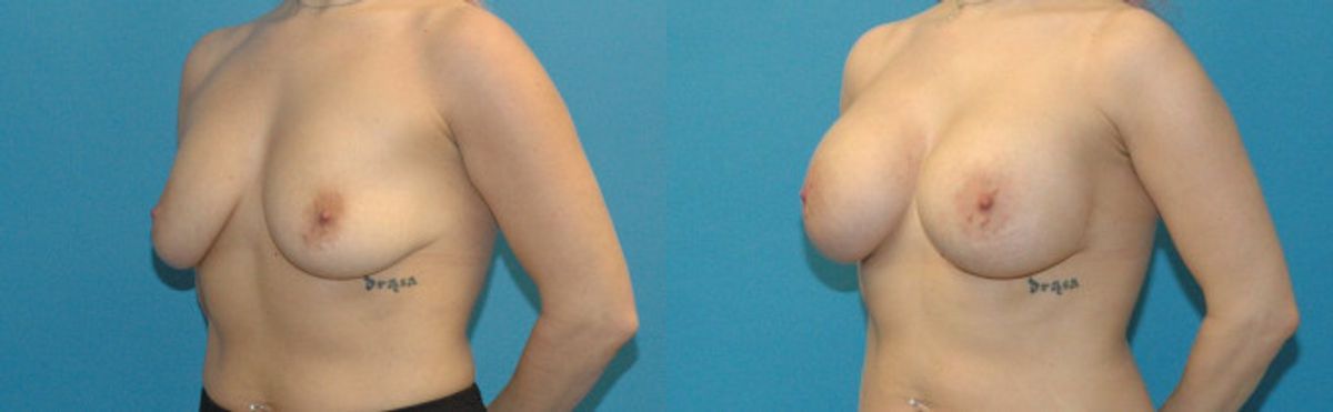 Breast Implant #91 - Before and After