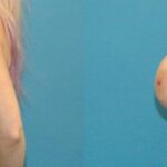 Breast Implant #91 - Before and After
