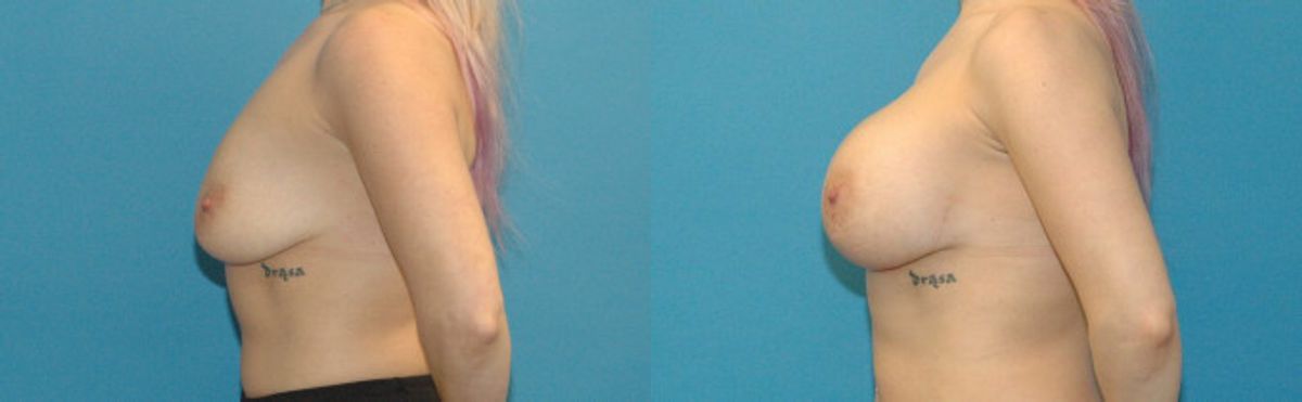 Breast Implant #91 - Before and After