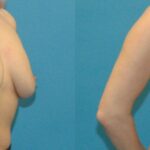 Breast Implant #91 - Before and After